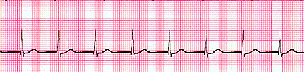 Accelerated Junctional Rhythm
