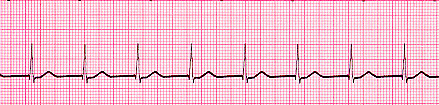 Accelerated Junctional Rhythm Accelerated Junctional Rhythm