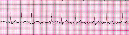 Atrial Fibrillation