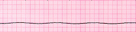 Asystole