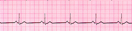 Sinus Bradycardia