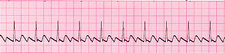 Atrial Flutter