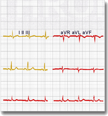 The QRS complex should be dominantly upright in leads I and II