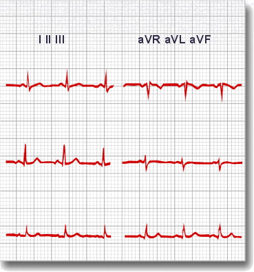 QRS and T waves tend to have the same general direction in the limb leads