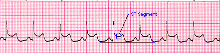 Myocardial Infarct