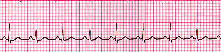 Normal Sinus Rhythm