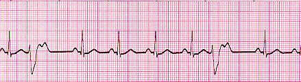 PVC's unifocal