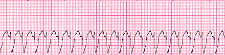 Ventricular Tachycardia