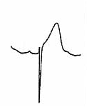 Hyperacute T Wave