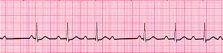 2nd degree Block Type 1