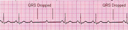 2nd Degree Block Type 2