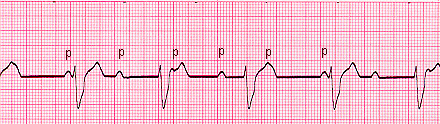 3rd Degree Block
