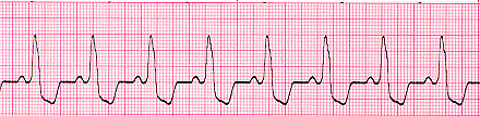 Bundle Branch Block