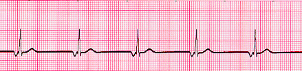 Junctional Rhythm