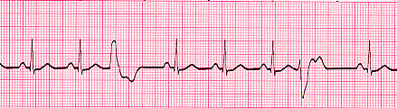PVC's multifocal