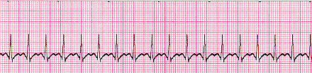 Supraventricular Tachycardia