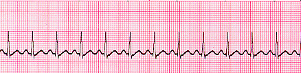 Sinus Tachycardia