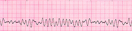 Ventricular Fibrillation
